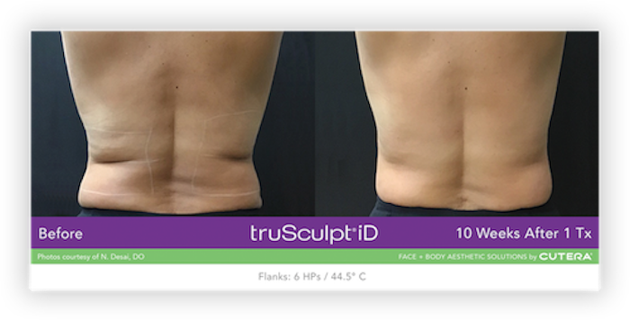 truSculpt® iD Before After 2